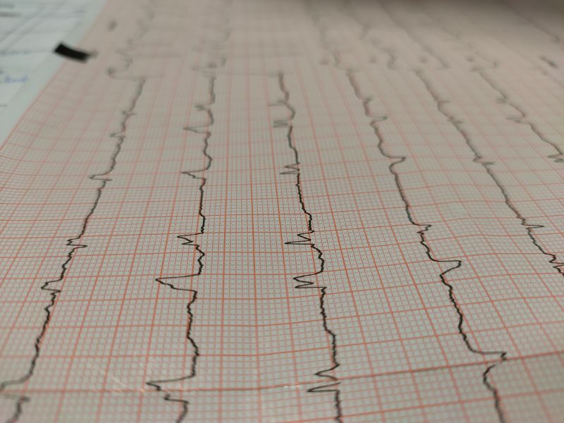 como ler um eletrocardiograma exame