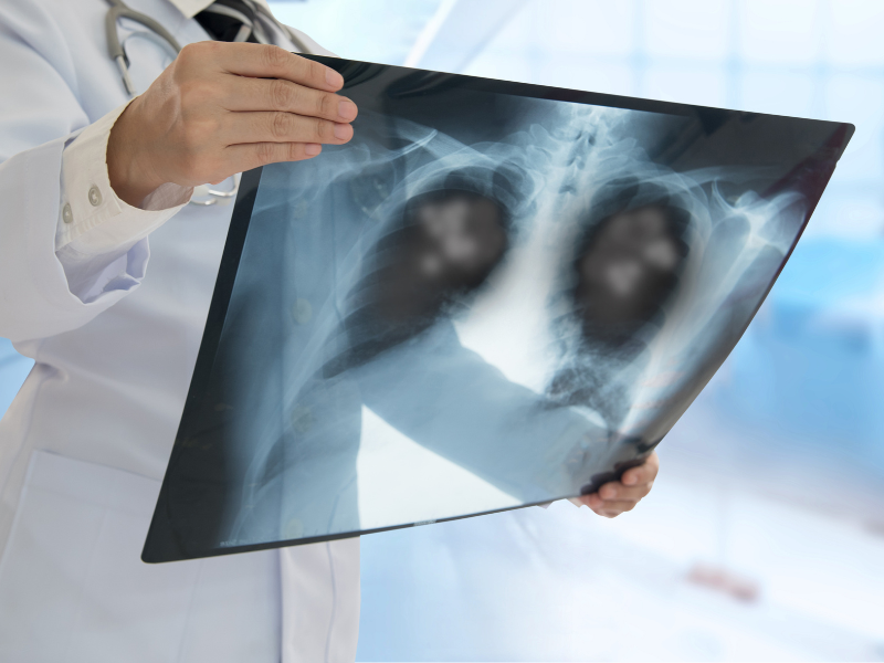 pneumonia associada à ventilação mecânica