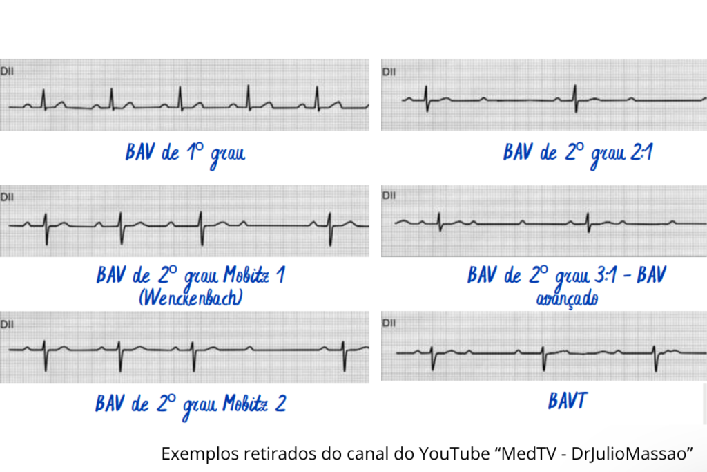 bloqueio AV ECG