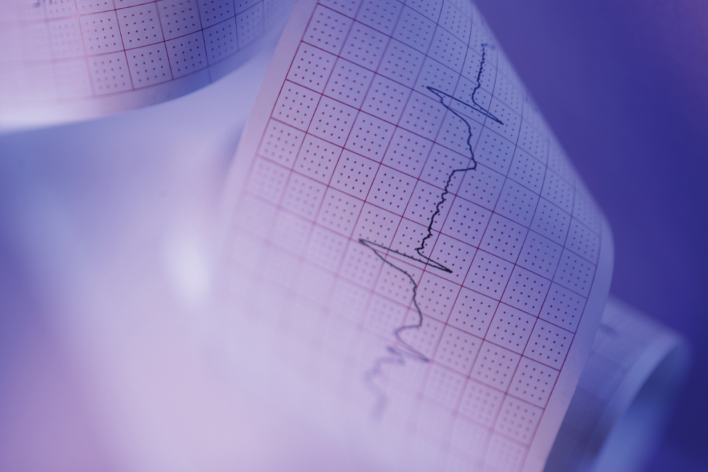 Taquicardia ventricular ECG