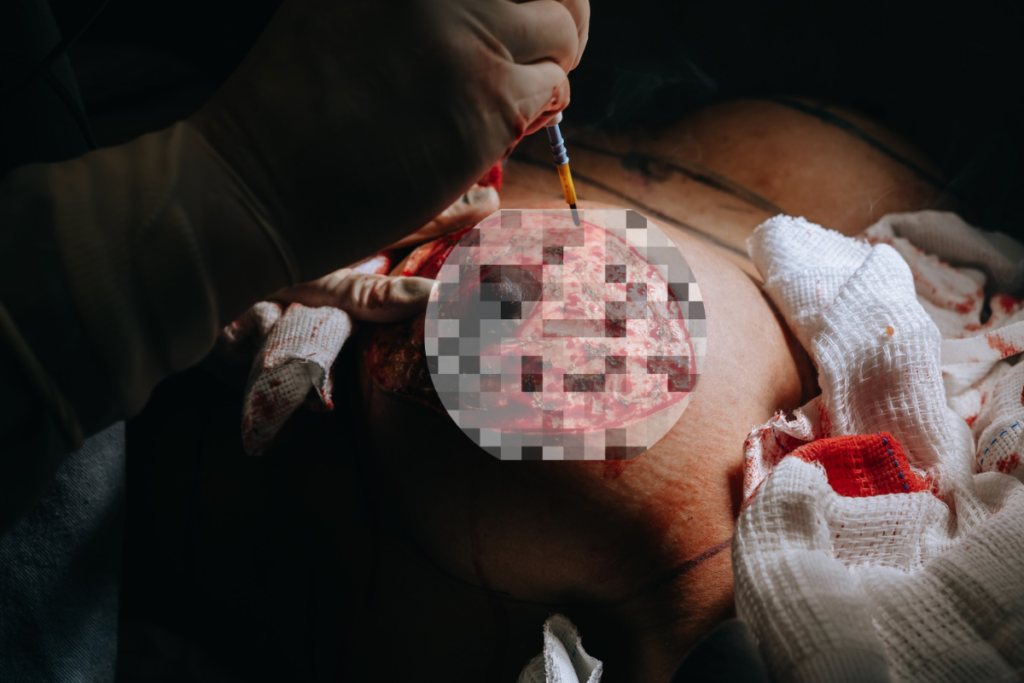 complicações mamoplastia