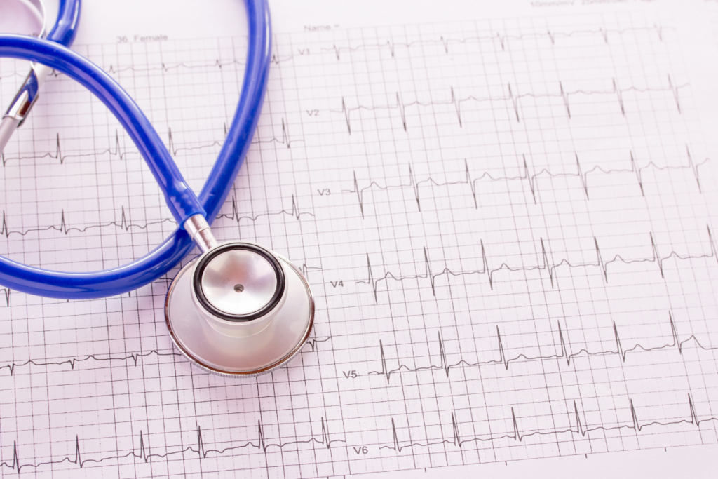 fibrilação atrial no ECG