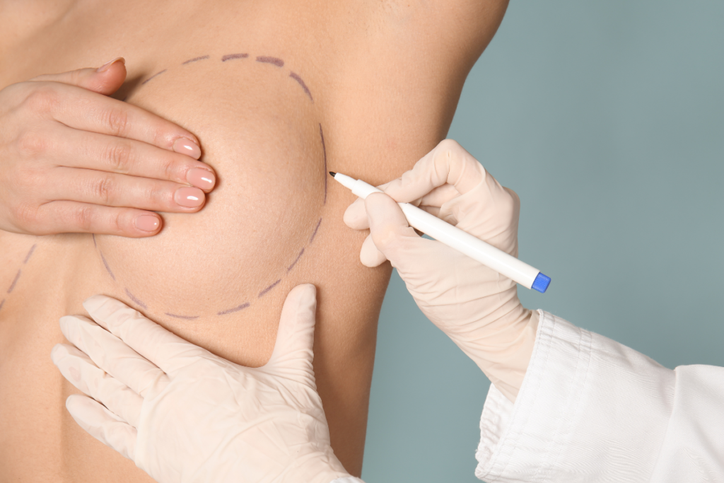 mamoplastia de aumento técnica