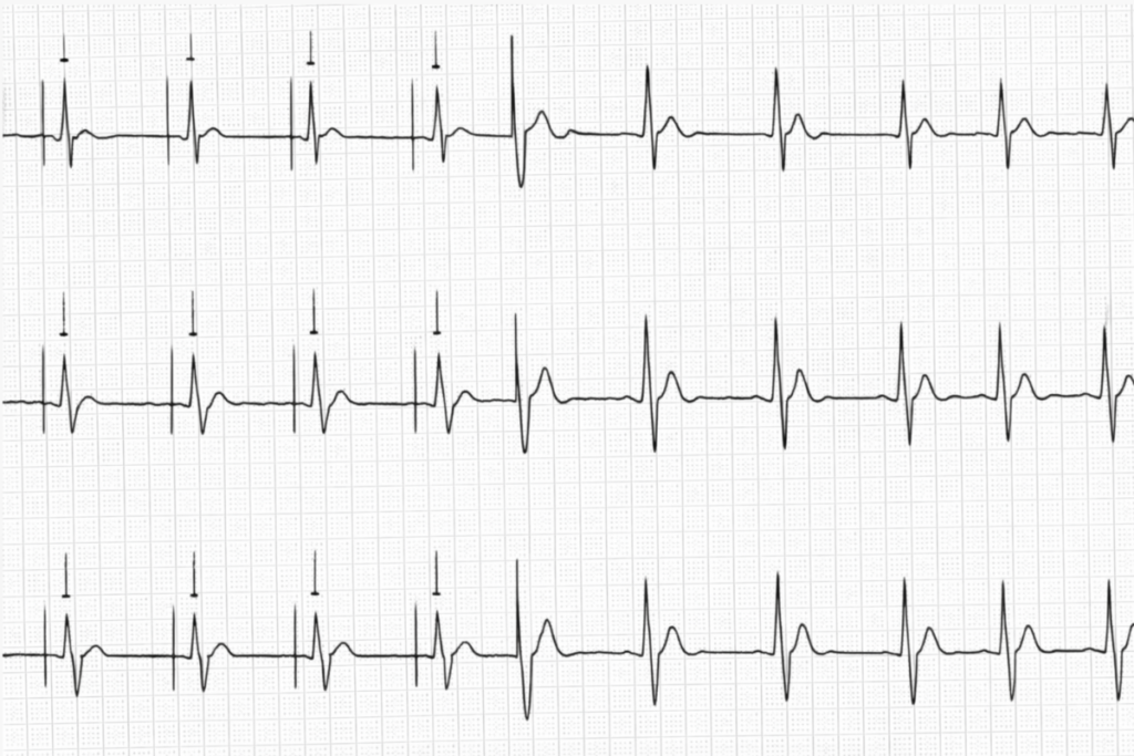 marca-passo no ECG