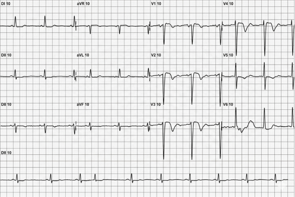 sobrecarga ventricular no ECG