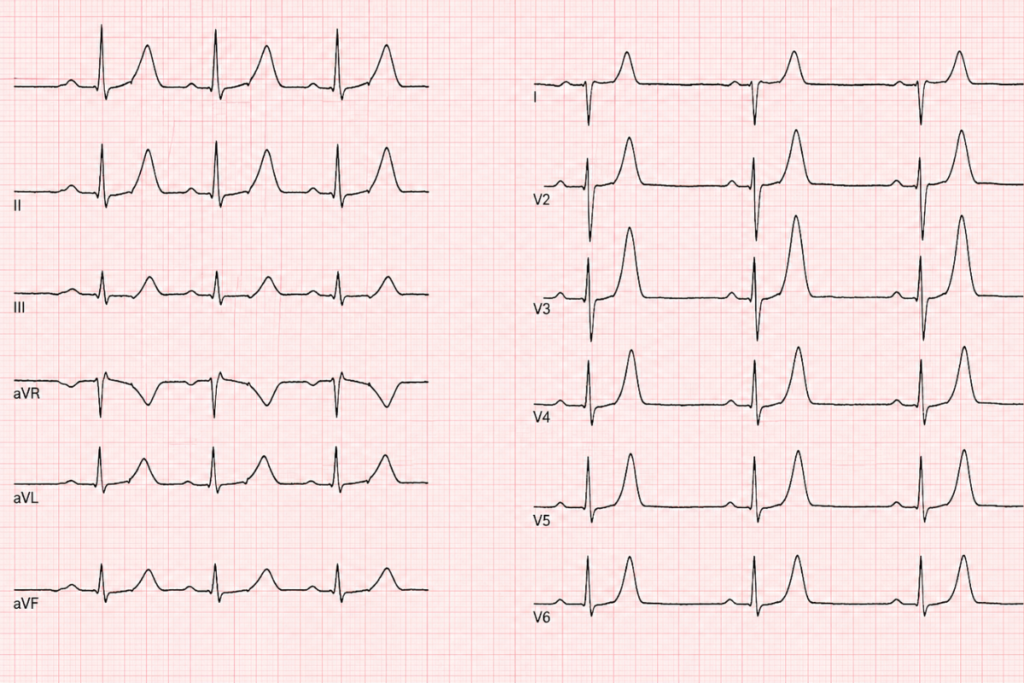 hipercalemia como identificar no ECGhipercalemia como identificar no ECG