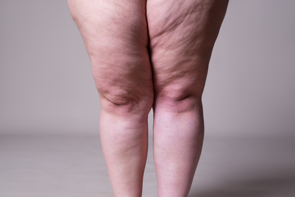 lipedema diagnóstico diferencial