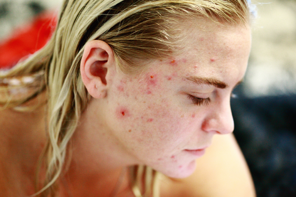 acne hormonal feminina adulta