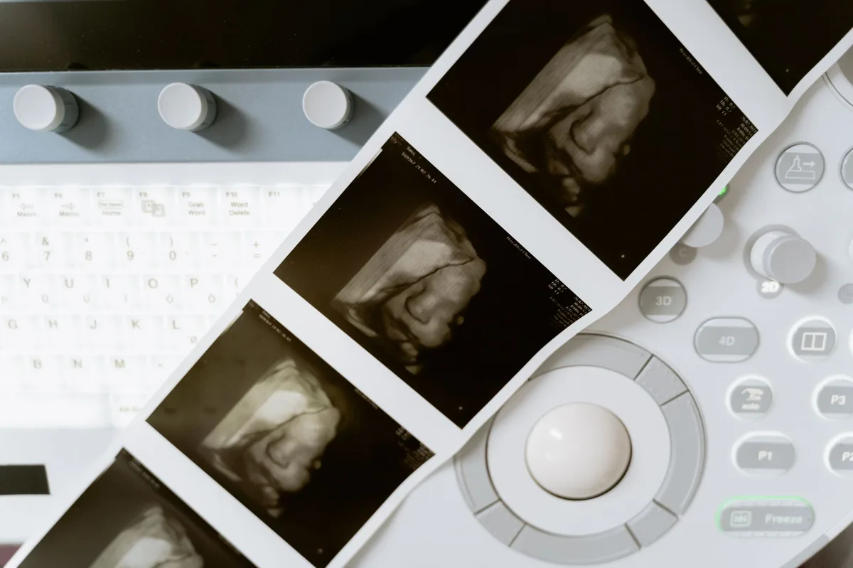 investigação do sangramento uterino anormal