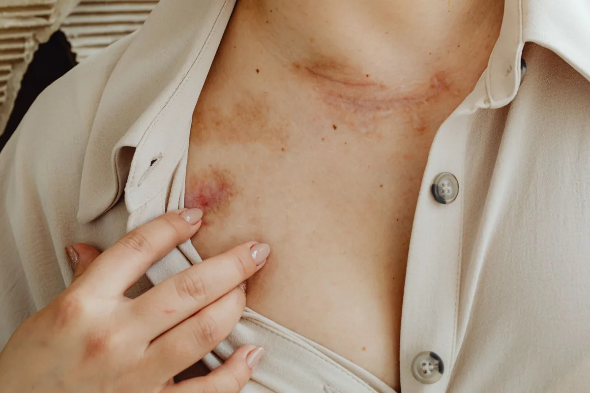 tratamento do herpes zóster