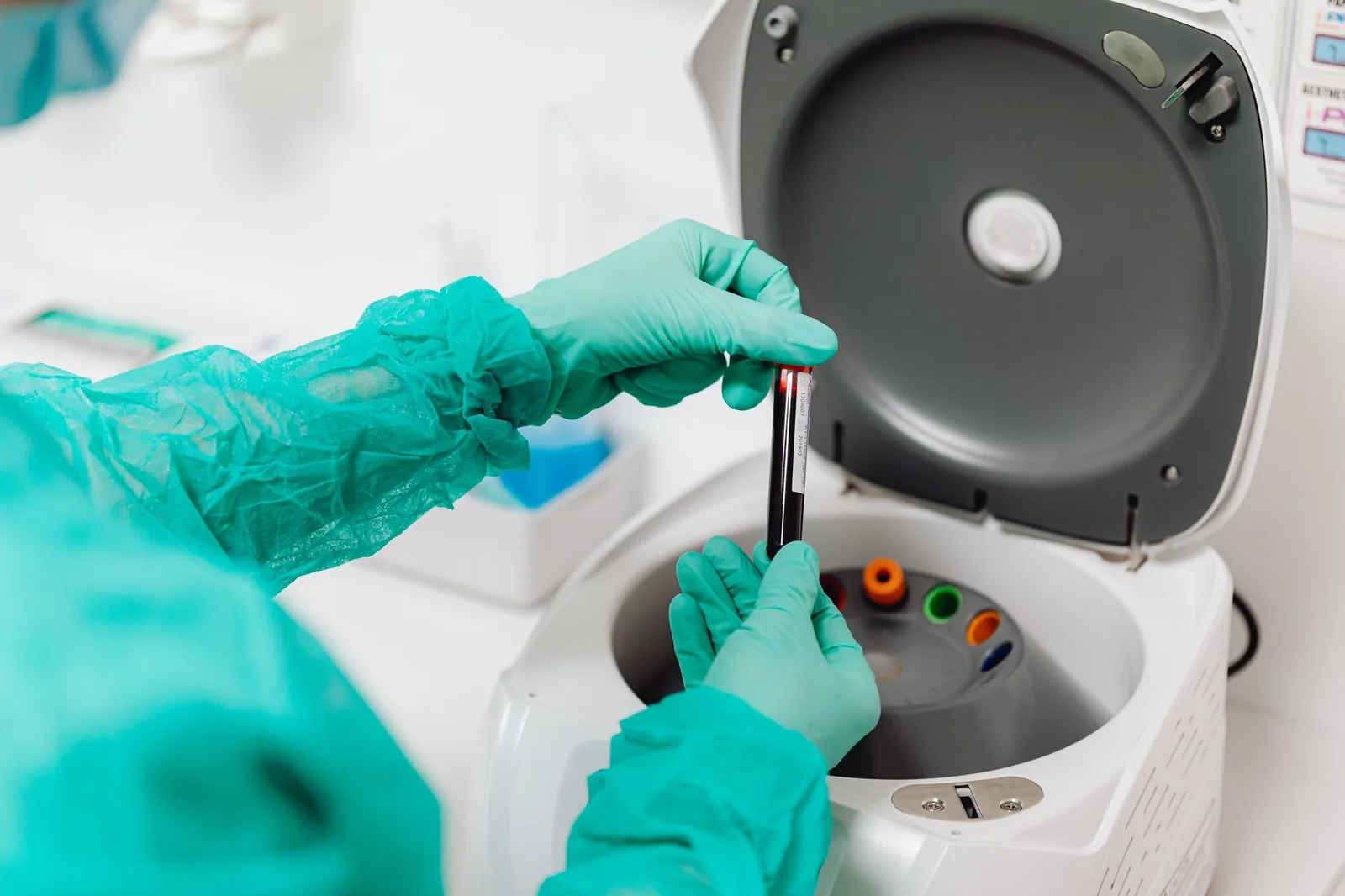 exame de sangue para Alzheimer