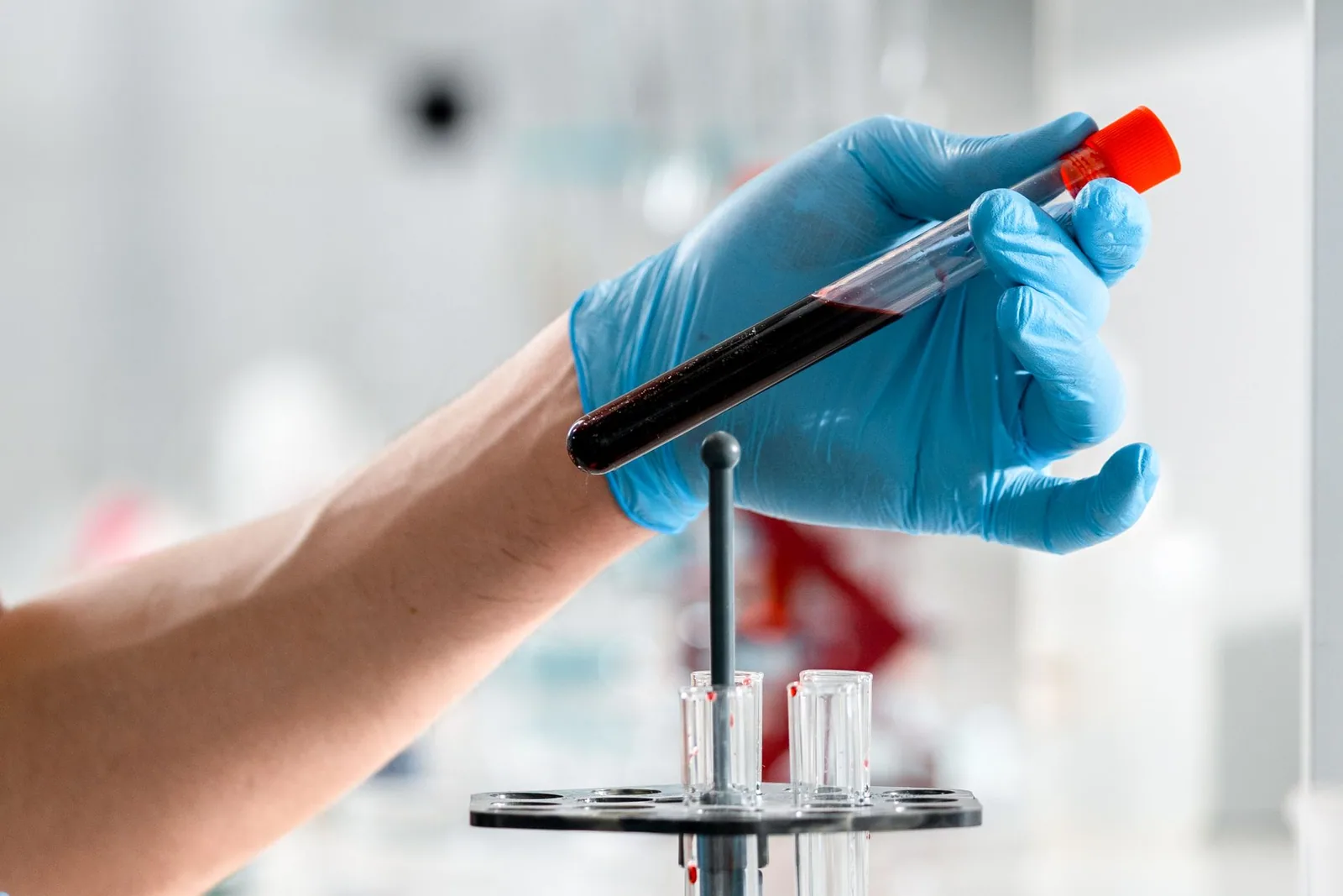 exame de sangue para Alzheimer