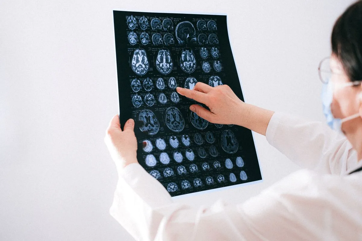 neuralgia do trigêmeo