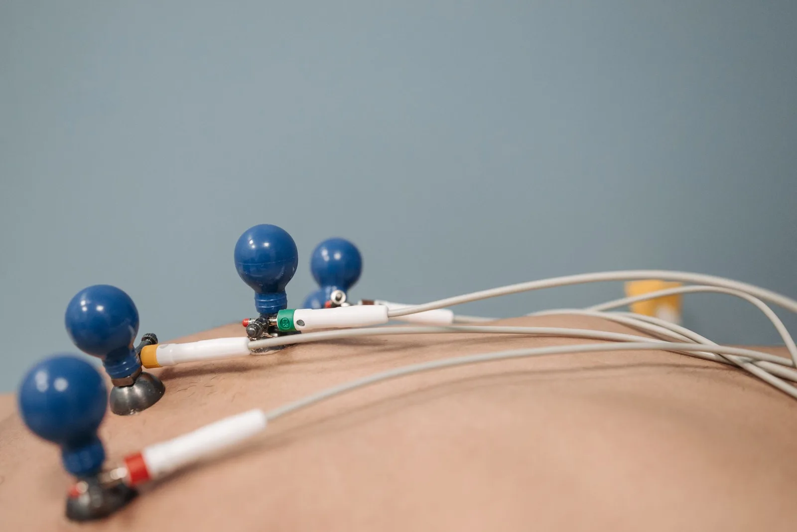 síndrome de Brugada no ECG